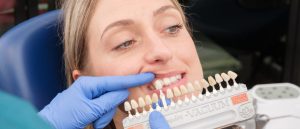 Estetica Dentale - Faccette
